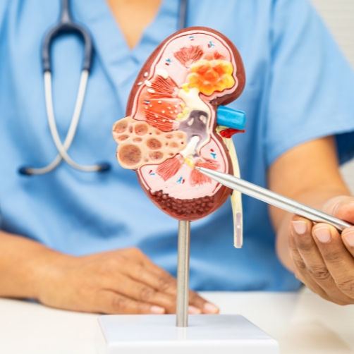 cálculos en en riñón